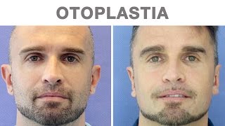 Otoplastia antes y después  Testimonio de David [upl. by Crutcher]