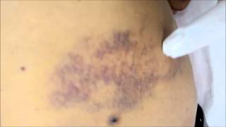 Bruise  Bruises meaning in Hindi Ecchymosis  Bluish discolouration of skin after trauma [upl. by Ahsekram]