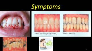 ANUG  severe gingivitis [upl. by Anstus]