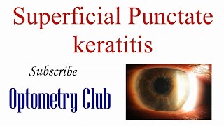 Superficial Punctate Keratitis Introduction Diagnosis and Treatment [upl. by Rabah258]