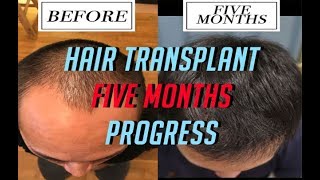 5 MONTHS Hair Transplant Update FUE Surgery Post Progress Results [upl. by Nhojleahcim]