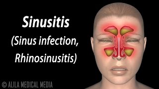 Sinusitis Animation [upl. by Resor]