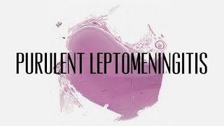 40 Purulent leptomeningitis [upl. by Faludi439]