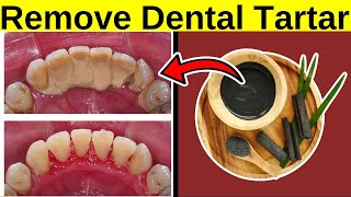 Remove Dental Tartar At Home NATURALLY [upl. by Perla]