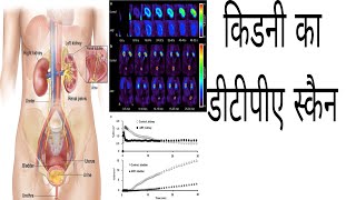 Kidney ka DTPA scan  Renal DTPA test in moderate hydronephrosis Awerenes of all [upl. by Anierdna]