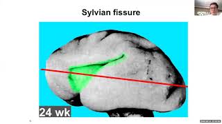 Cortical Malformations Olus Api [upl. by Nalyt]