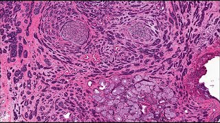 Salivary gland Polymorphous adenocarcinoma and differential [upl. by Drallim]