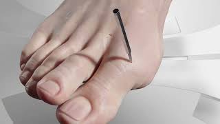 Minimally Invasive Hallux Valgus Bunion Surgery [upl. by Willing]