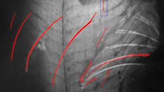 Fish bones detection in an Xray image [upl. by Hanfurd565]