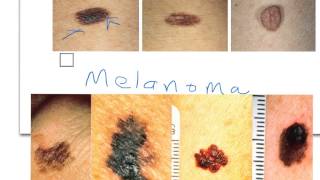 Nevi vs Melanoma [upl. by Notserp]