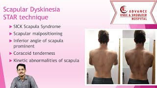 Shoulder Dyskinesia STAR technique Role of Scapular Rehabilitation [upl. by Forland]