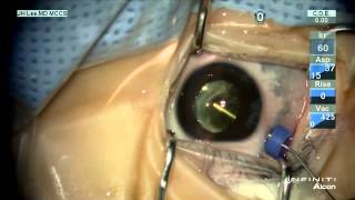 HD Surgery for visual axis opacification [upl. by Lonergan]