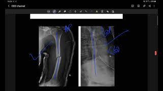 fracture shaft humerus acceptability criteria [upl. by Larina]