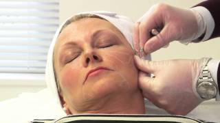 Facial rejuvenation with dermal fillers [upl. by Yelena]