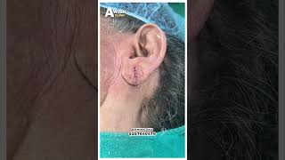 Ear Piercing Before amp After See the Difference Awish Clinic [upl. by Anyrb723]