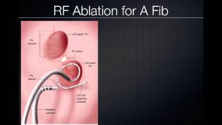 Pulmonary Vein Ablation Cardiac CT [upl. by Pearline764]