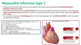 【CV疾病專題導讀】Myocardial infarction [upl. by Theo]