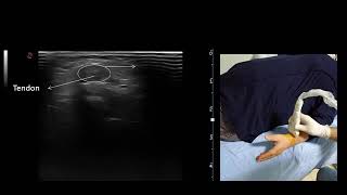 Ultrasound guided De Quervains Tenosynovitis injection [upl. by Greenwald910]