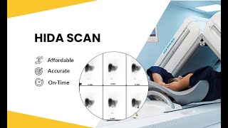 Bile Scintigraphy  Hepatobiliary Iminodiacetic acid Scan HIDA SCAN [upl. by Tuhn]