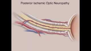 Ischemic Optic Neuropathies [upl. by Phemia]