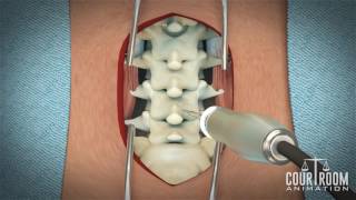 Lumbar Discectomy Surgery Medical Animation [upl. by Selinski467]