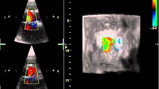 AORTIC LEAK 4D ECHOCARDIOGRAPHY [upl. by Brenn760]